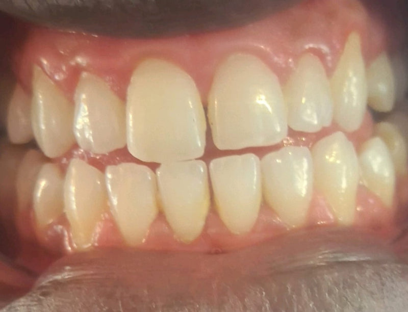Dents après un traitement par aligneurs transparents
