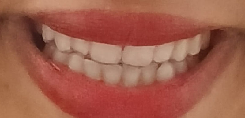 Dents après un traitement par aligneurs transparents